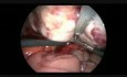 Salpingoowariektomia laparoskopowa z powodu obecności dużego potworniaka