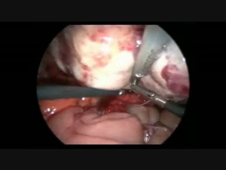 Salpingoowariektomia laparoskopowa z powodu obecności dużego potworniaka