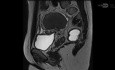 Laparoskopia w asyście robotycznej. Resekcja endometriozy głębokonaciekającej #ENZIAN P2, O3/0, T0/x, B 3/2, A2, C2, FA