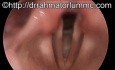 Wygląd fałdów głosowych podczas fonacji - obraz widziany z użyciem endoskopu sztywnego (kąt widzenia 70 stopni)