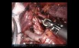 Trisegmentektomia płata górnego płuca lewego z użyciem robota