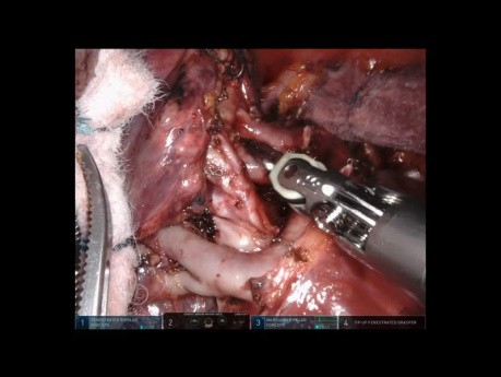 Trisegmentektomia płata górnego płuca lewego z użyciem robota