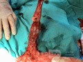 Gruczolakorak na podłożu przełyku Barrett'a - obraz endoskopowy (15 z 20)