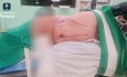 Laparoskopowa prawostronna adrenalektomia z limfadenektomią z powodu guza nadnercza o wymiarach 5 × 5 cm