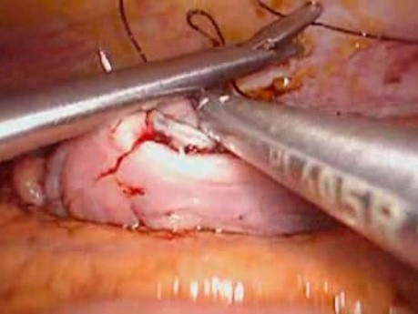 Perforacja okrężnicy z zapaleniem otrzewnej - laparoskopia (16 z 46)