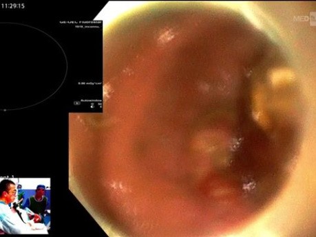 Zabieg ERCP z zastosowaniem gastroskopu