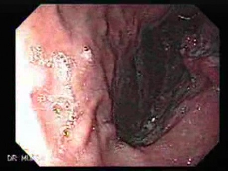 Gruczolakorak żołądka z żylakami - endoskopia (2 z 8)
