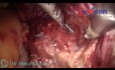 Laparoskopowa histerektomia z poprzedzającym cesarskim cięciem