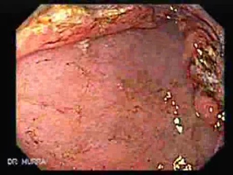 Rak gruczołowy jamy odźwiernikowej (2 z 5)