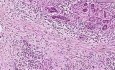 Gruczolakorak - Badanie histopatologiczne trzustki