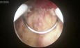 Histeroskopowa resekcja przerośniętego endometrium