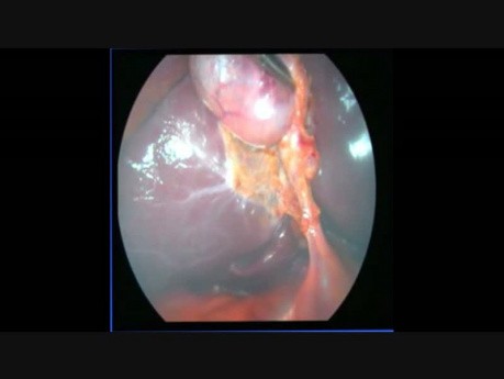 Cholecystektomia laparoskopowa z wykorzystaniem trzech portów