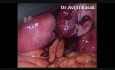 Postępowanie laparoskopowe w przypadku jajnikowej ciąży ektopowej