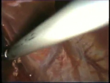 Konwersja laparoskopowej fundoplikacji Nissena do miotomii sposobem Toupet
