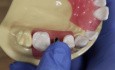 Closed Tray Impression Coping - How to Take A Closed Tray Impression