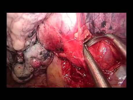 Anatomiczna górna lewa trisegmentektomia wykonana metodą Uniportal VATS (film nieedytowany) 