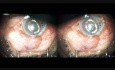 PC IOL, Open Angle Glaucoma, Microtrack Filtration, In 3D also 2D