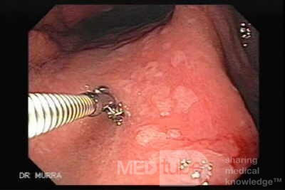 Rak żołądka - metaplazja jelitowa - endoskopia (7 z 7)