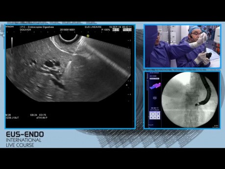 Hepatogastrostomia pod kontrolą EUS (EUS-BD)