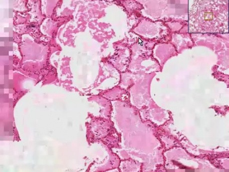 Ostry obrzęk płuc - ciałka azbestowe. Histopatologia płuc
