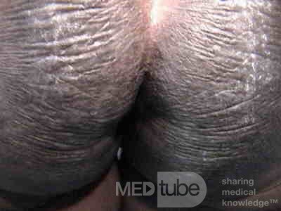 Acanthosis Nigricans (7 z 7)