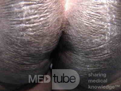 Acanthosis Nigricans (7 z 7)