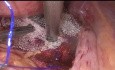 Podwieszenie macicy techniką laparoskopową