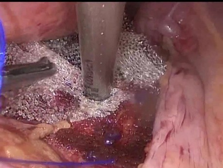 Podwieszenie macicy techniką laparoskopową