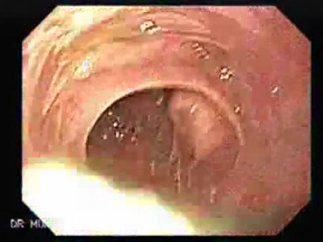 Gruczolakorak wpustu żołądka - bliższe spojrzenie na brodawkę Vatera, część 1