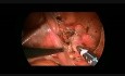 Laparoskopowa resekcja torbieli moczownika u dziecka