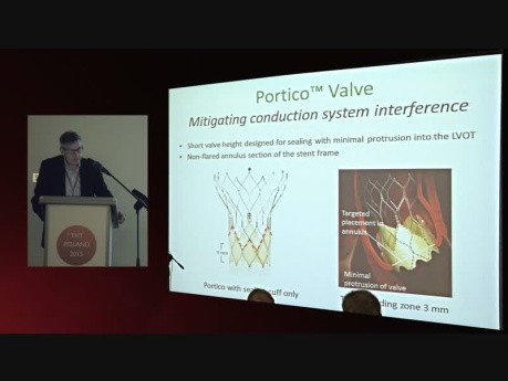 Zastosowanie St Jude Portico Valve w leczeniu natywnej zastawki aortalnej