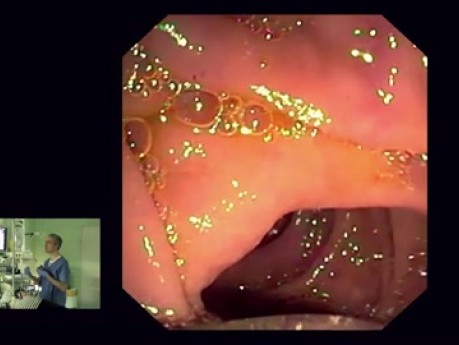 Endoskopowa ultrasonografia – przypadek 4