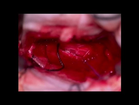 Przepuklina wewnątrzoponowa (intradural) krążka międzykręgowego