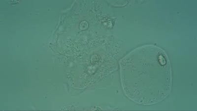 Bakteryjne zapalenie pochwy - Komórki jeżowe