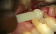 Nowoczesny sposób leczenia resorpcji zewnętrznej korzenia zęba