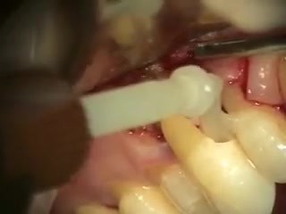 Nowoczesny sposób leczenia resorpcji zewnętrznej korzenia zęba
