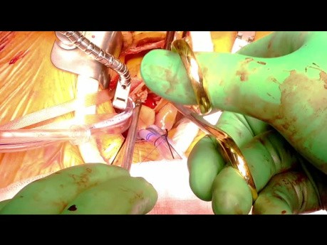 Wymiana zastawki aortalnej poprzez prawą przednią torakotomię. Proteza Avalus.