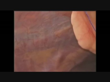 Laparoskopowa operacja nawracającej przepukliny pępkowej