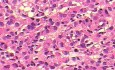 Mały gruczolakorak żołądka typu rozlanego raka żołądka z komórkami sygnetowatymi (5 z 19)