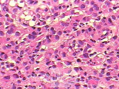 Mały gruczolakorak żołądka typu rozlanego raka żołądka z komórkami sygnetowatymi (5 z 19)