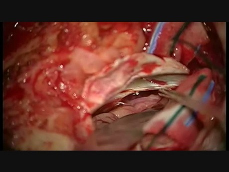 Dwie operacje resekcji podnamiotowych torbieli naskórzastych (epidermoid, cholesteatoma, perlak)