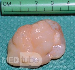 Polip nozdrzy tylnych wyrastający z tylnej części przegrody (wycinek chirurgiczny)