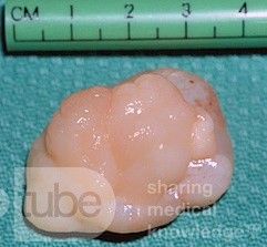 Polip nozdrzy tylnych wyrastający z tylnej części przegrody (wycinek chirurgiczny)