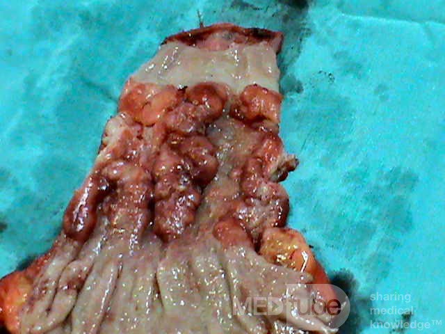 Gruczolakorak na podłożu przełyku Barrett'a - obraz endoskopowy (18 z 20)