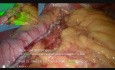 Resekcja rękawowa żołądka z wykorzystaniem zieleni indocyjaninowej (ICG)