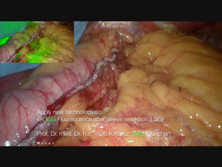 Resekcja rękawowa żołądka z wykorzystaniem zieleni indocyjaninowej (ICG)