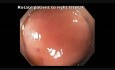 Komplikacje mukozektomii endoskopowej (EMR) - krwawienie z kątnicy - klip D