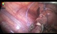 Laparoskopowa appendektomia u 12-letniego chłopca