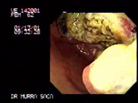 Gruczolakorak żołądka - niedrożność - endoskopia