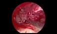 Endoskopowa tympanoplastyka rewizyjna w przewodzeniowym ubytku słuchu